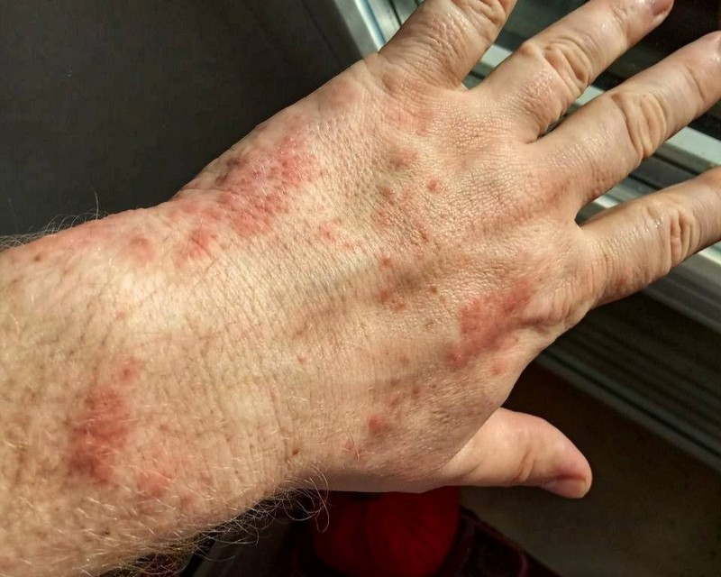 Искусанная клопами рука беларуса, который сидел в брестском ИВС. Фото Сергея Мельянца